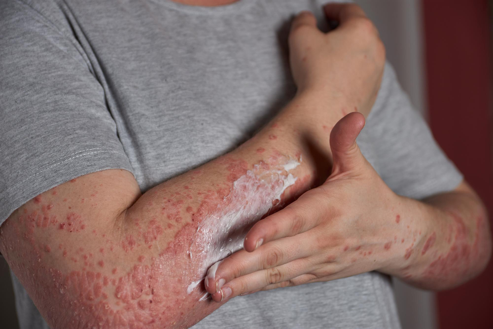 Dyshidrotic Eczema | UVTREAT